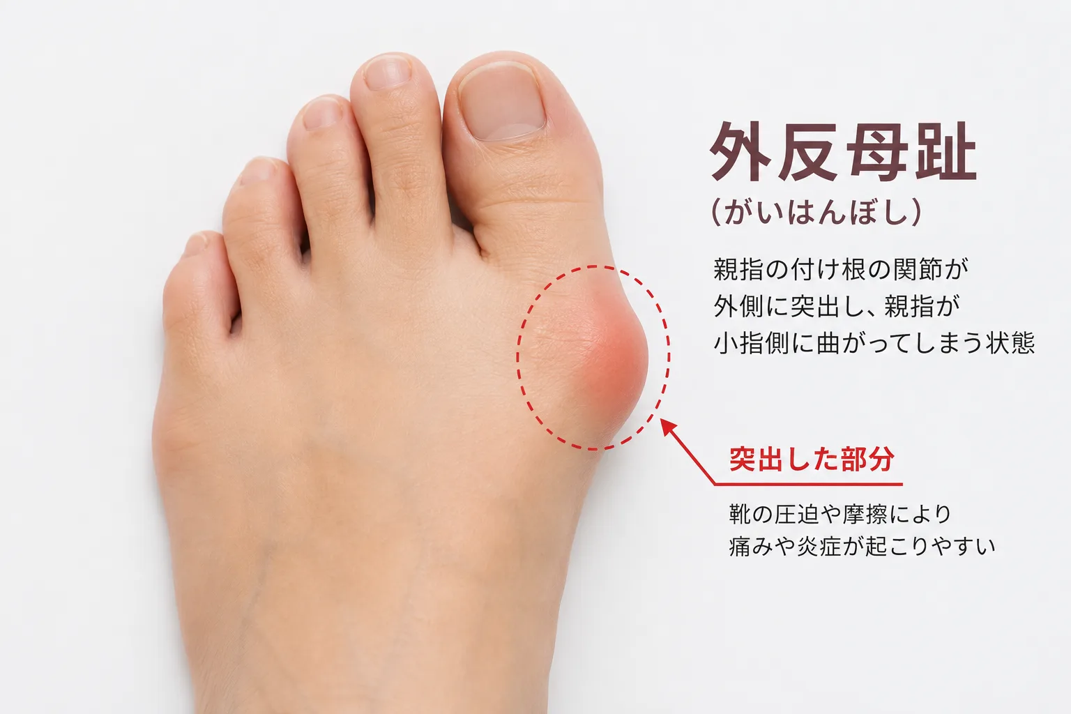 外反母趾のイラスト。親指の付け根の関節が外側に突出し、親指が小指側に曲がっている状態を示す